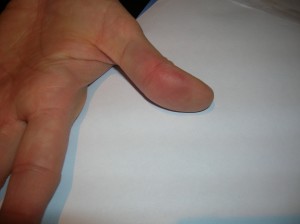 Thumb_after